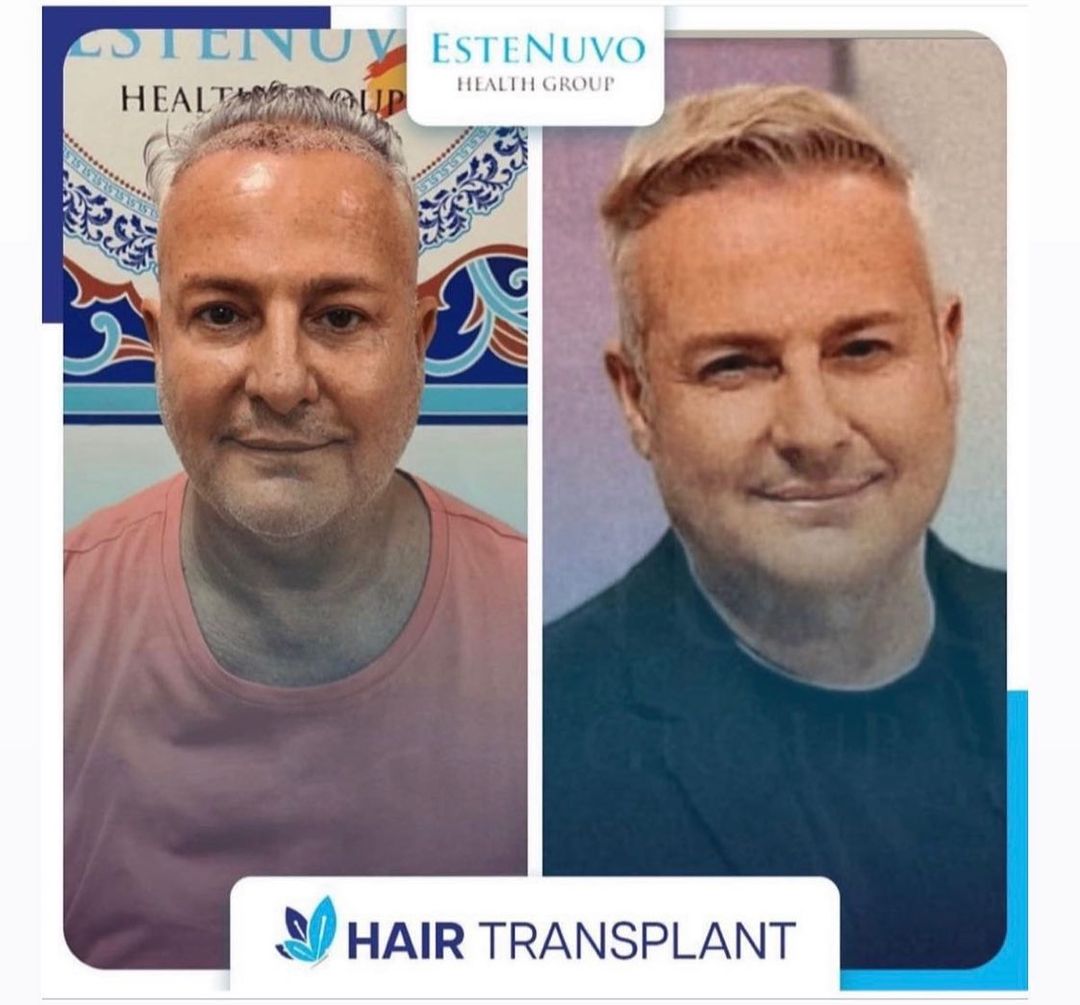 Resultado antes y después de un trasplante capilar de EsteNuvo